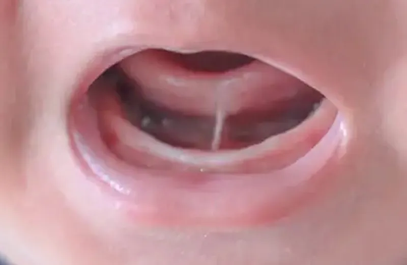 Frenectomia e teste da linguinha